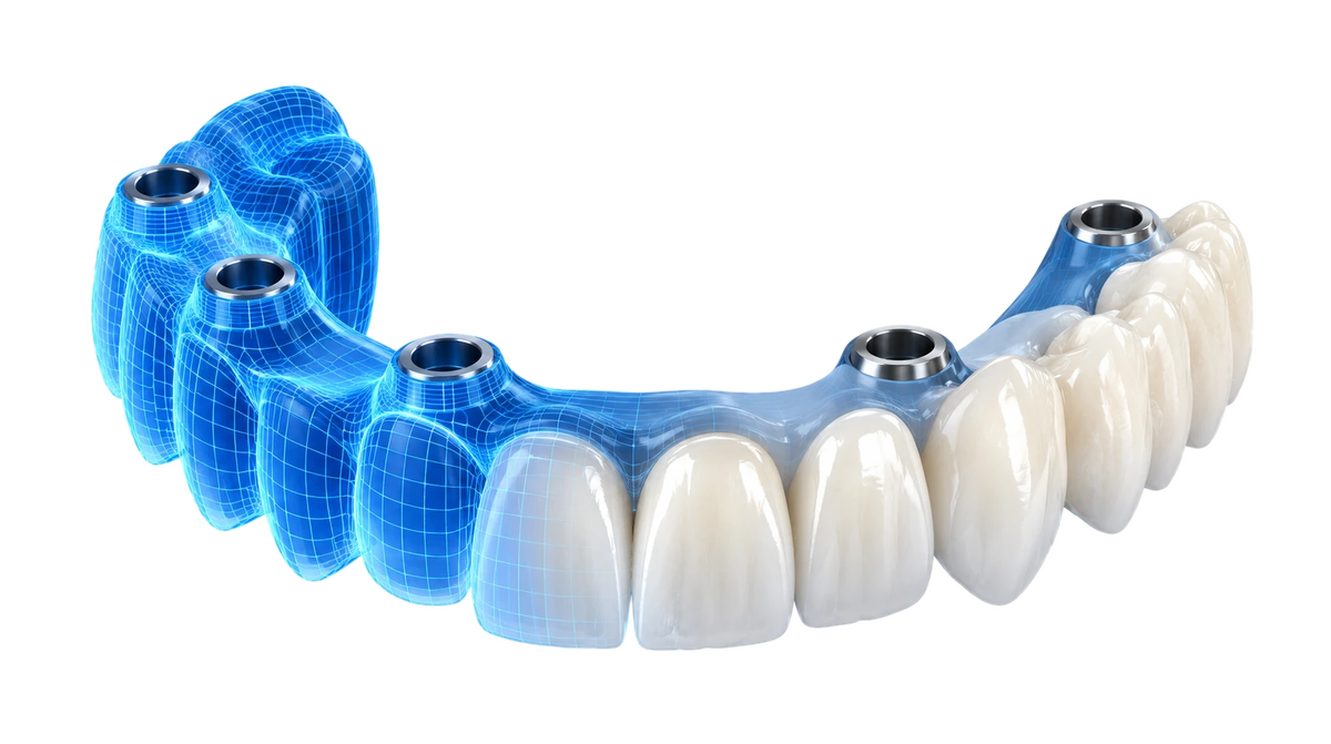 Dise&ntilde;o CAD de rehabilitaci&oacute;n completa