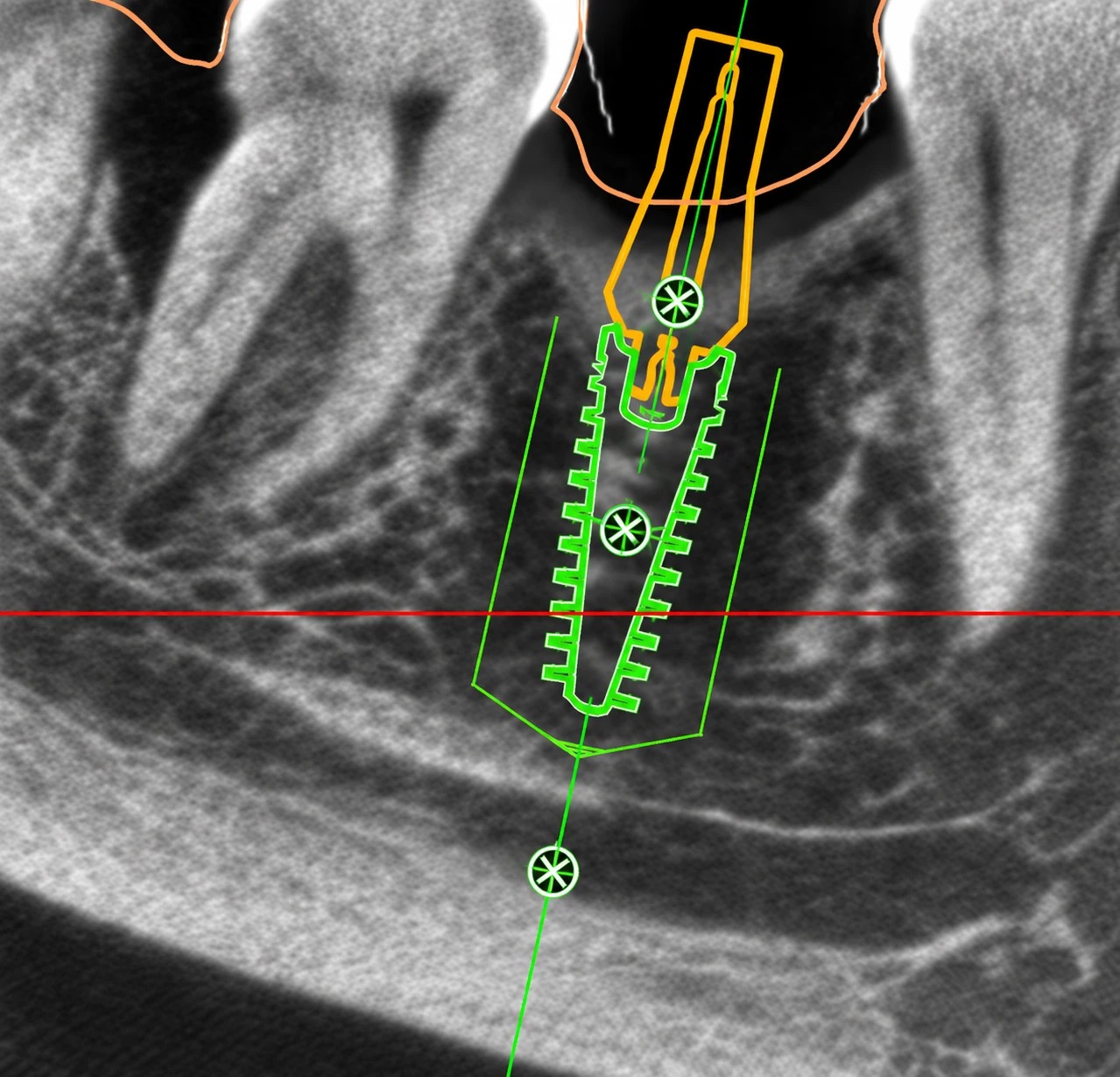 Planificación 3D del implante sobre el CBCT