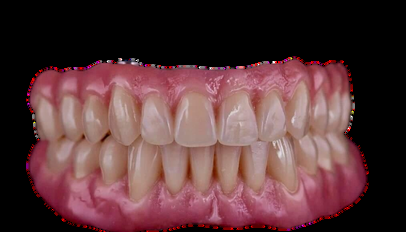 Pr&oacute;tesis Completa