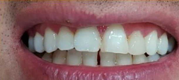 1 · Sonrisa inicial